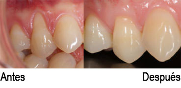 antes y despues cirugia mucogingival periodoncia almeria clínica dental enfermedad de las encías