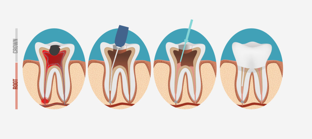 endodoncia