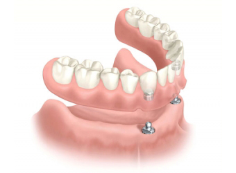 Prótesis dental removible completa