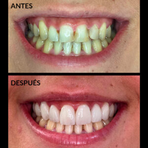 caso-clinico-carillas-dentales-almeria-antes-y-despues-estetica-dental