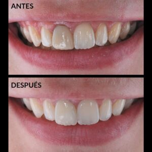 caso-clinico-carillas-dentales-almeria-antes-y-despues
