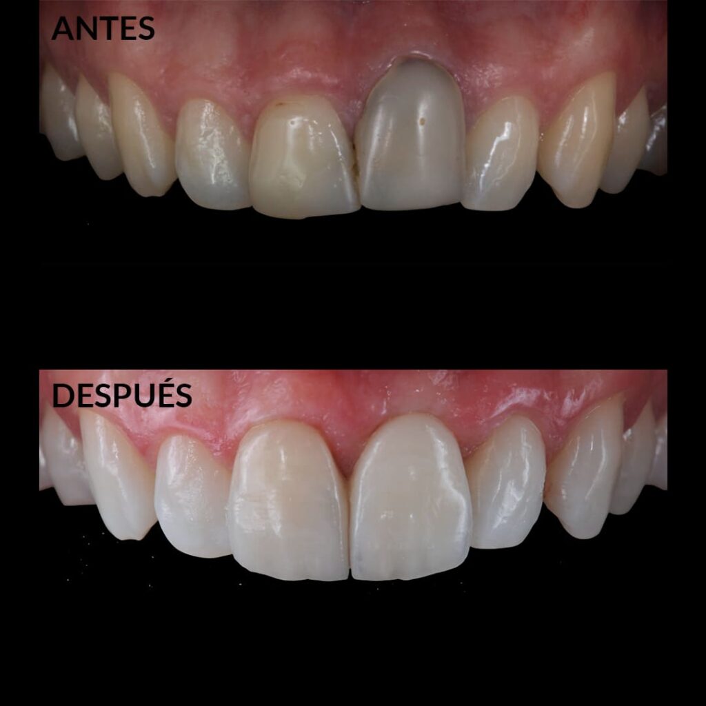 Carillas Dentales | Tratamiento, Tipos Y Ventajas | Estética Dental Almería