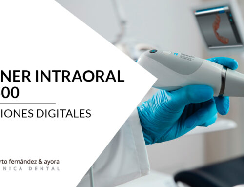 Impresiones digitales Almería | Escáner intraoral CS 3600