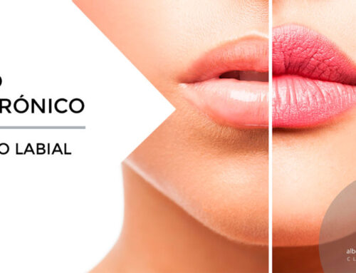 Lip augmentation with hyaluronic acid in Almería
