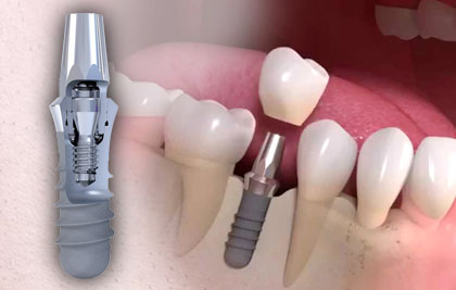 Dental implants application