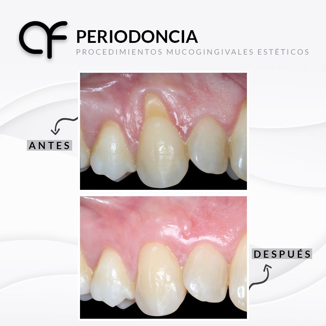 Antes y despu´es periodoncia